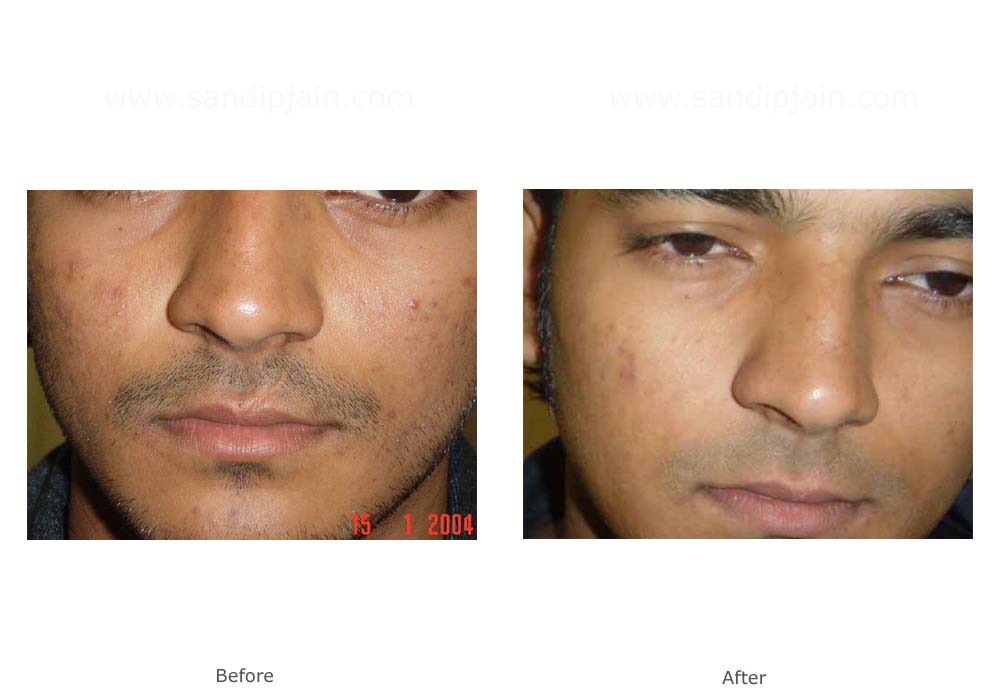 Scar Revision Gallery Dr Jain Before And After Photos