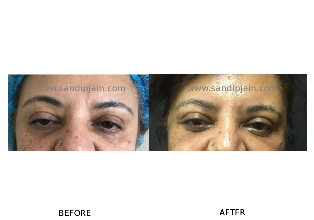 Blepharoplasty_2_
