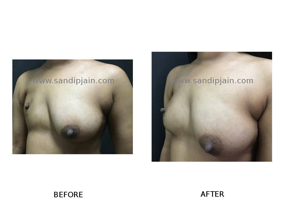 Absence of right breast from birth. Following 2 session of fat grafting  (with Aquashape liposuction device) there is breast mound on the right  side. - Dr Jain