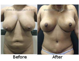 mommymakeover10