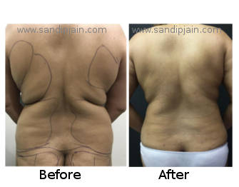 mommymakeover11