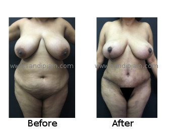 mommymakeover12