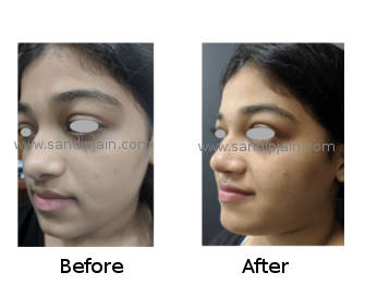 nosejob1