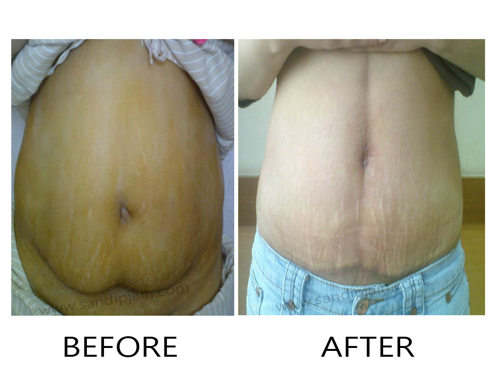 Abdominoplasty before after 01