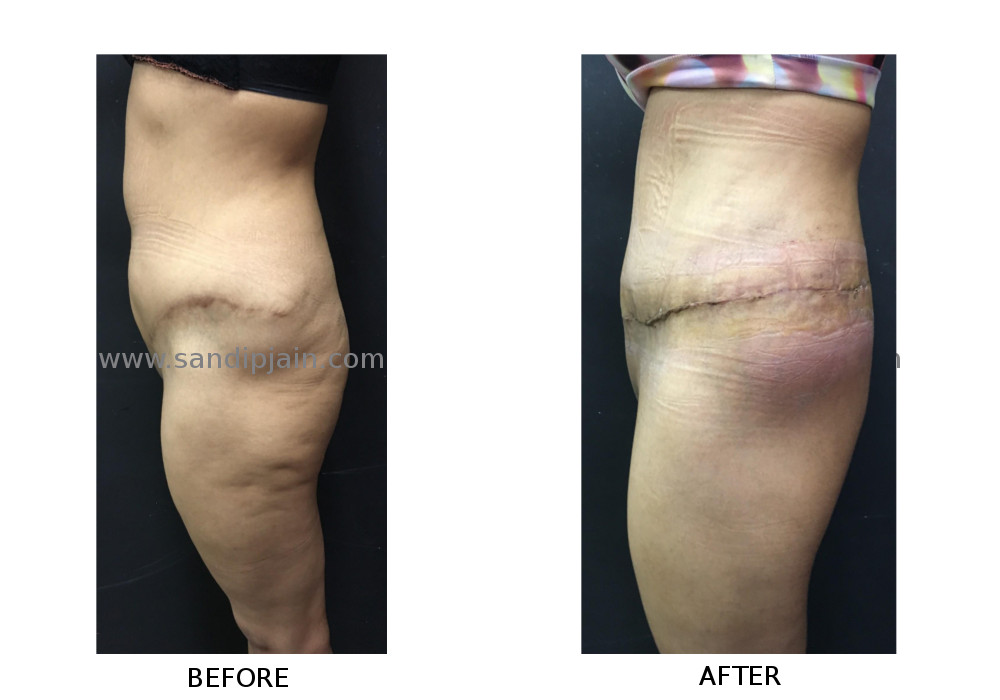 Body Lift Surgery Before and After Photos in Charlotte - H/K/B