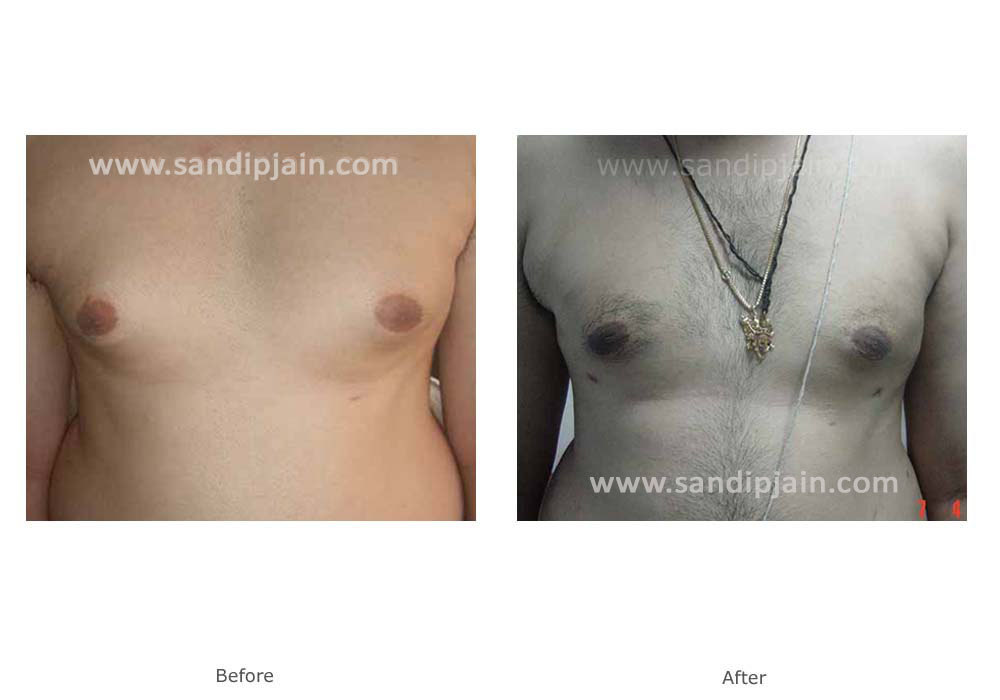 30 year old male with enlargement of breast tissue on both sides.  Combination of Liposuction and breast tissue excision was done to achieve  normal chest contour. - Dr Jain