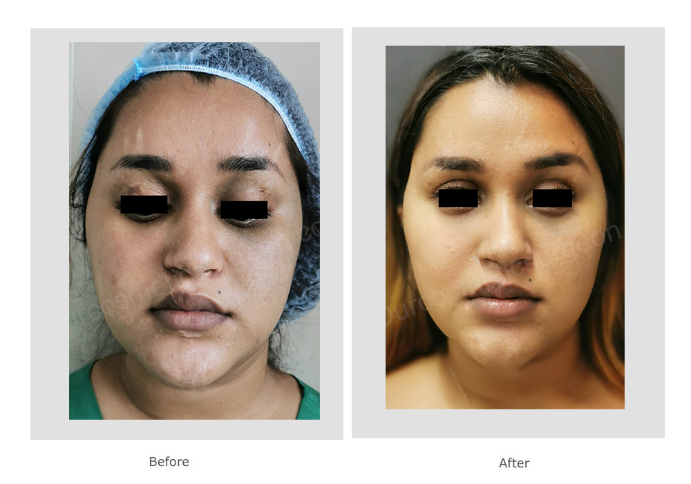 Before: patient requesting change from round to more angular face along with  improvement in scars and better jawline. After: following fat grafting to cheek bone area, lower eyelids and scars, buccal fat pad excision, scar revision and liposuction of jawline