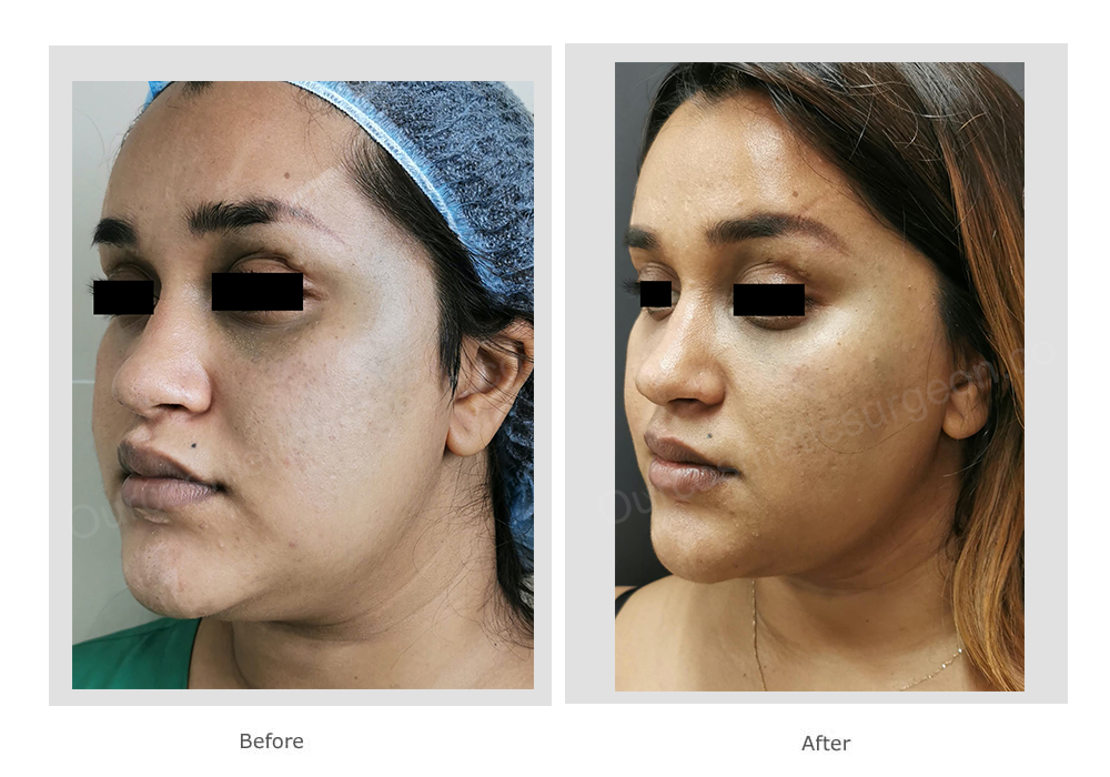 Before: same patient from oblique view After: improvement in the scar under the lower lip, more angular and slimmer appearance of face, better jawline definition and high cheekbones with lightening of lower eyelid pigmentation