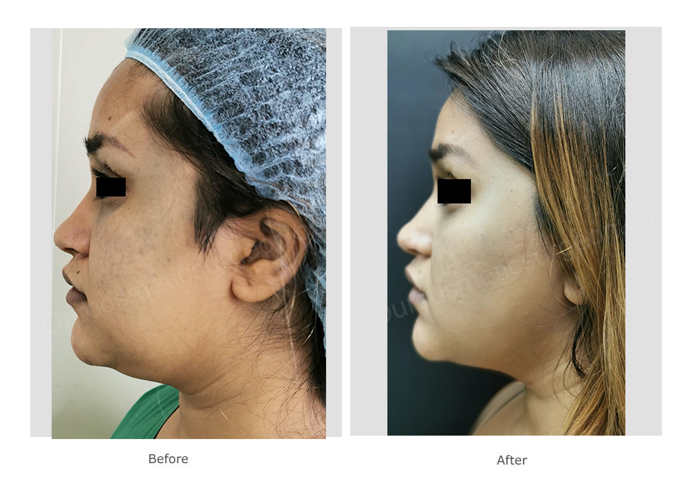 Before: same patient from left side showing the double chin After: correction of double chin with liposuction