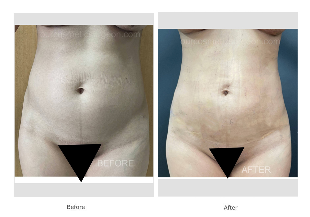 Before: After : 360 degree smart lipo of the tummy area - Dr Jain