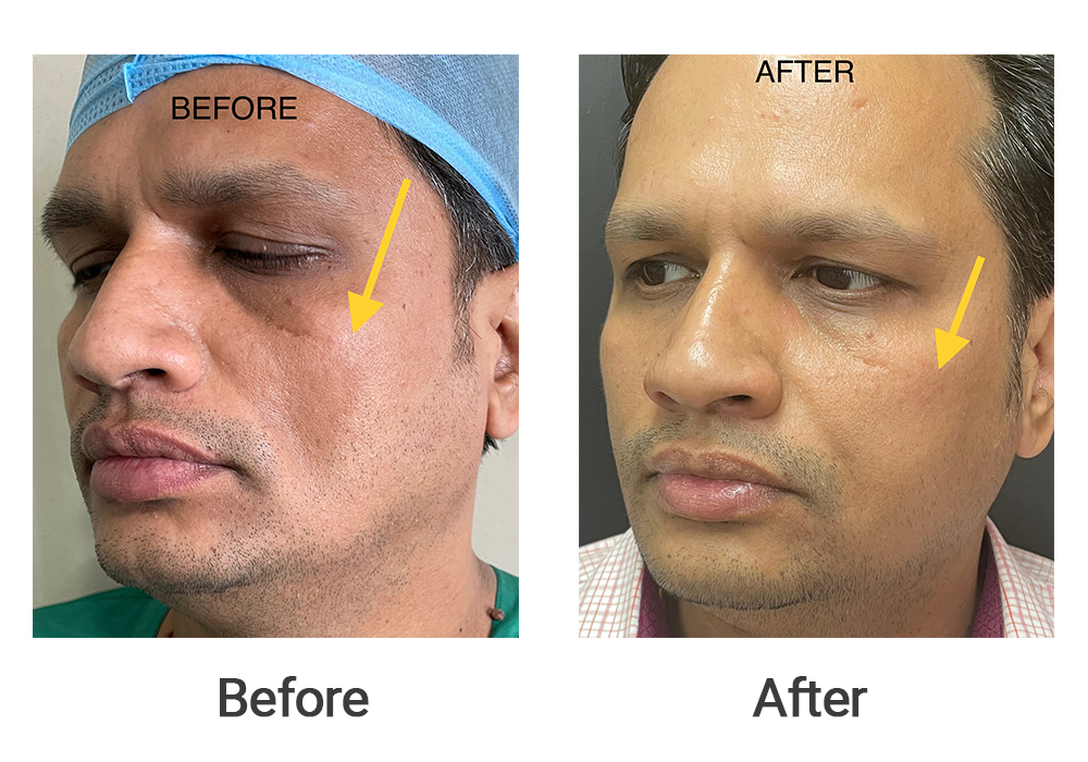 This gentleman had a dent on his left cheek(arrow) following a dental procedure. It was corrected by injecting his own fat into the left cheek.  There were no scars or stitches taken. No wonder fat is also called liquid gold!