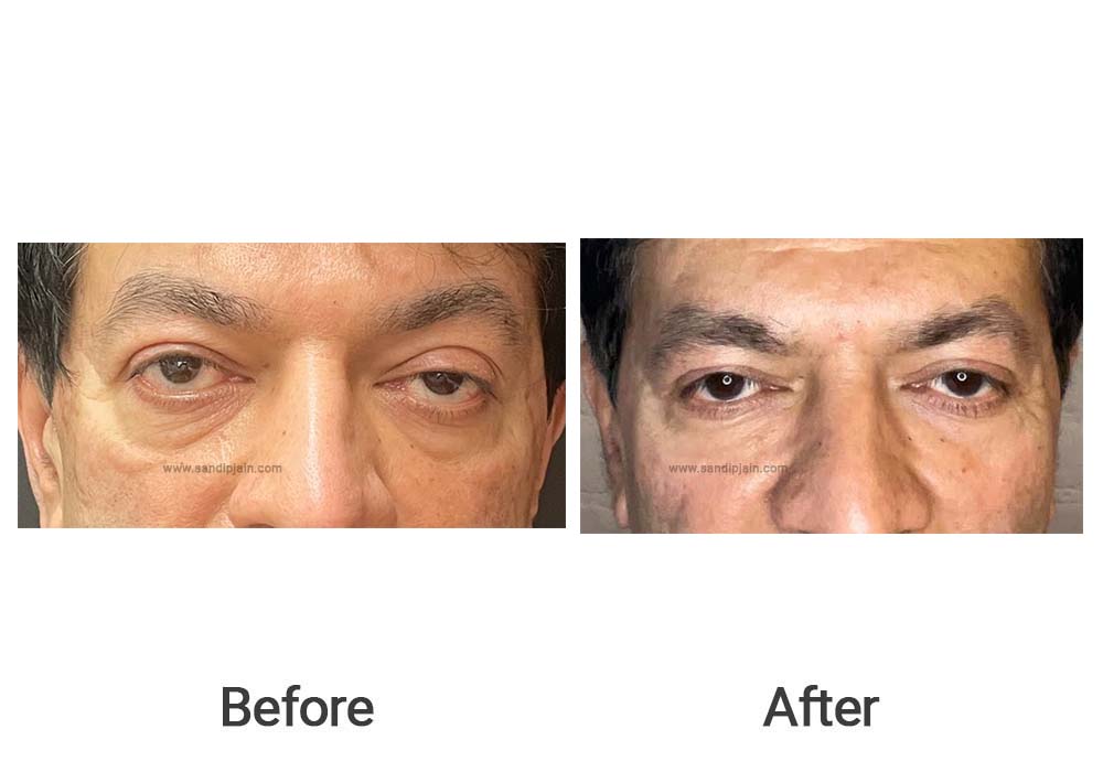 Dark circles and hollowness of eyelids  improved after fat grafting