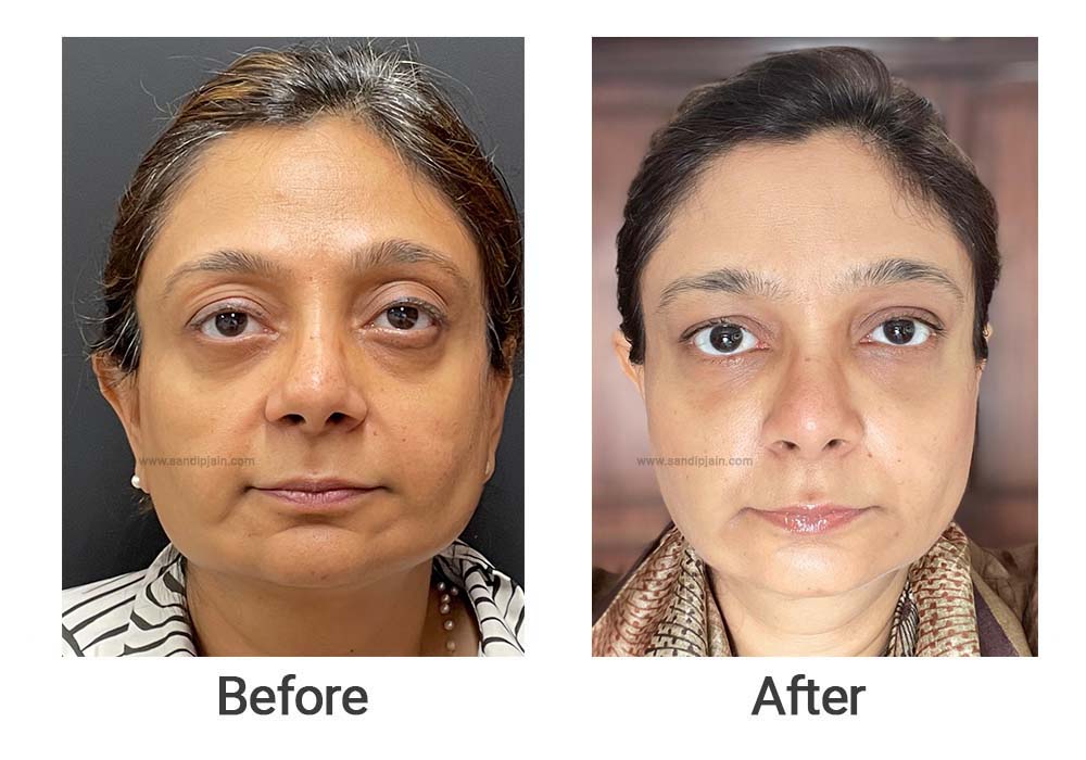 After fat injection to different areas of the face.
