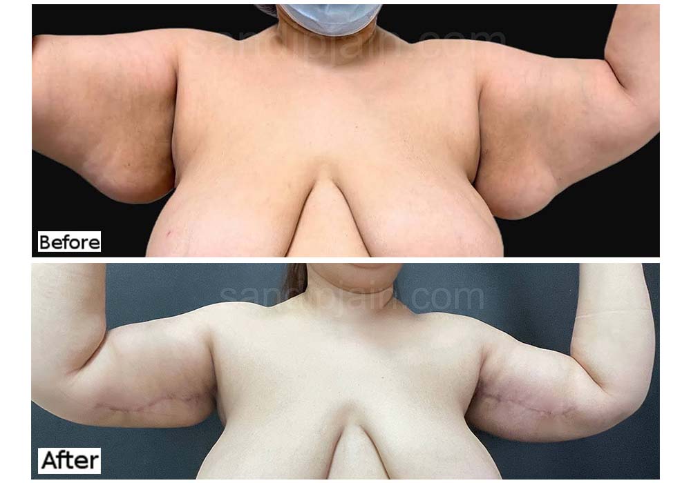 Before: heavy arms and folds on the side of chest. After: arm lift. - Dr  Jain