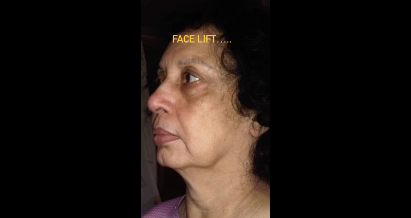 Face Lift: surgical procedure to rejuvenate face and neck area