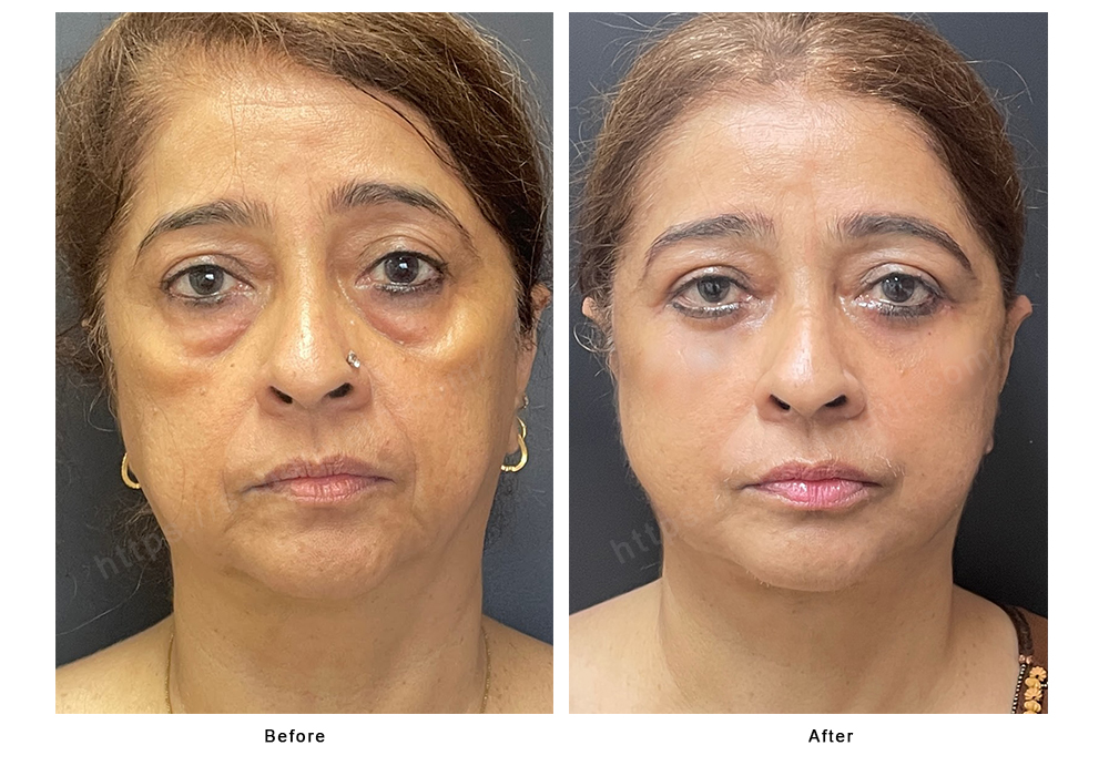 Before <br> After face and neck lift + Lower lid blepharoplasty +fat fgrafting