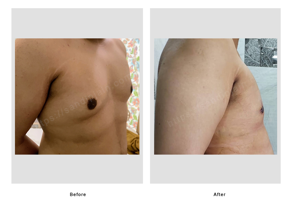 Gynecomastia Before & After Gallery: Patient 61