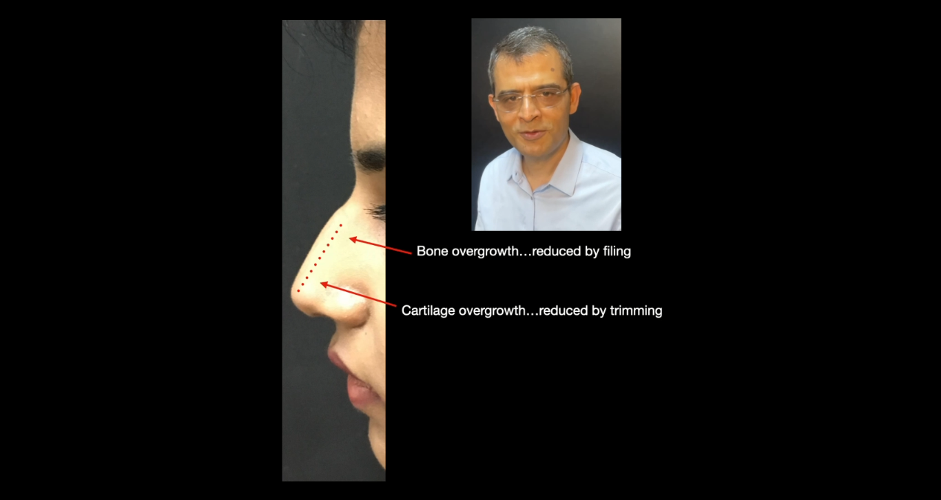 Correction of Tension Nose deformity with open rhinoplasty surgery