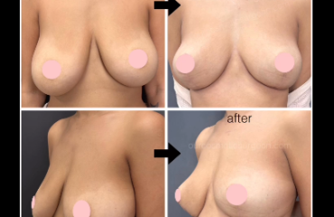 Breast lift (mastopexy)
