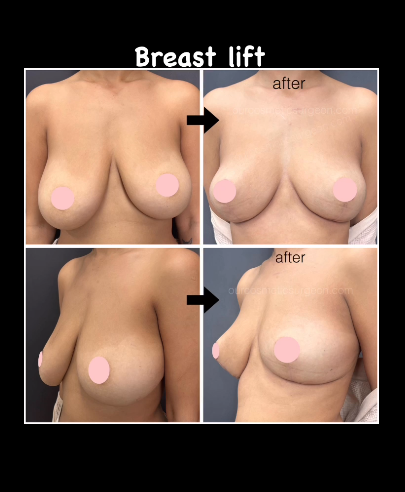 Breast lift (mastopexy)