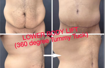 Lower body lift (360 degree tummy tuck) with oblique flankplasty