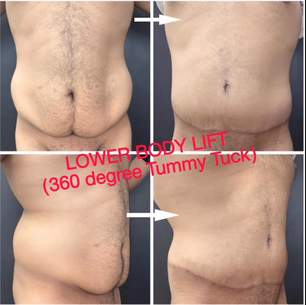 Lower body lift (360 degree tummy tuck) with oblique flankplasty