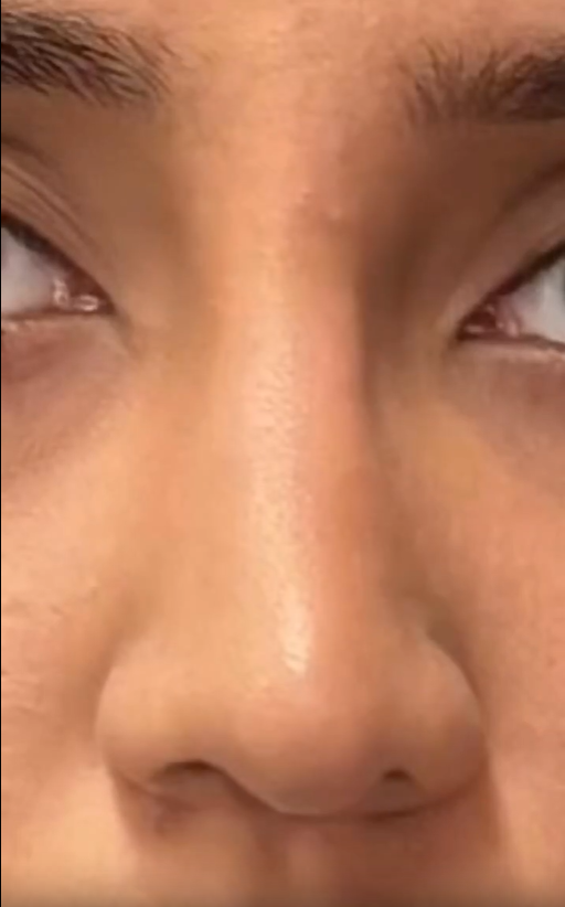 Revision Septorhinoplasty