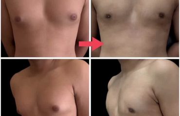 Gynaecomastia grade 1