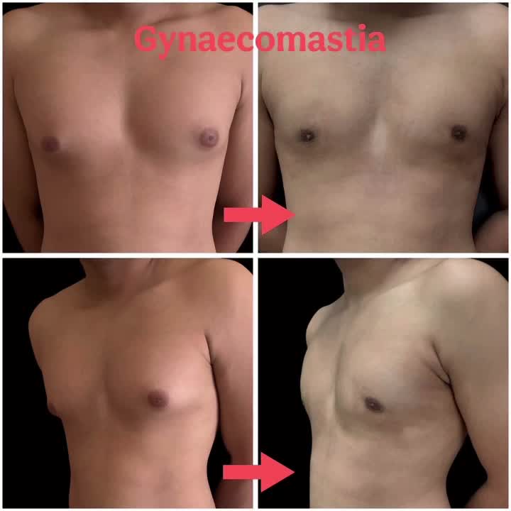 Gynaecomastia grade 1