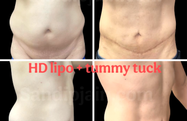 HD lipo + Tummy tuck