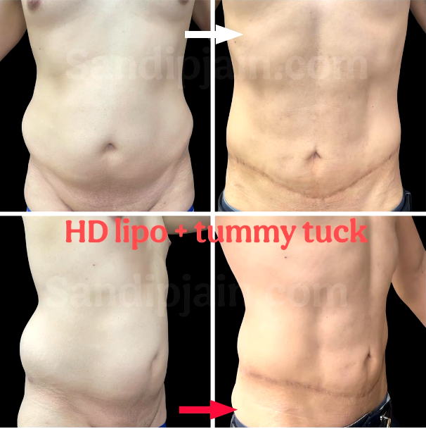HD lipo + Tummy tuck