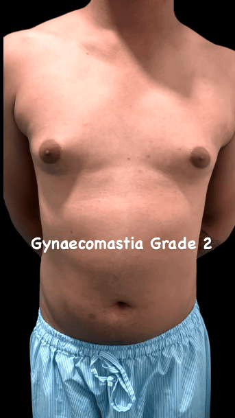 Gynaecomastia – Grade 2