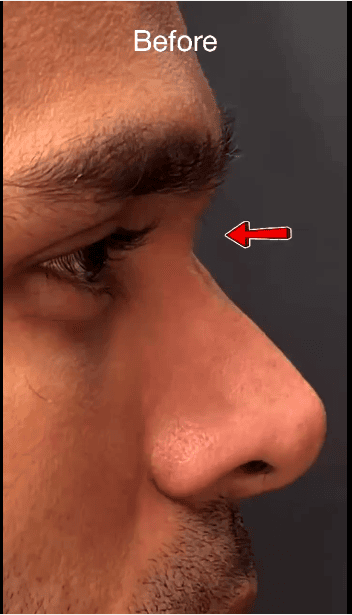 Depressed root of nose ( short nose)