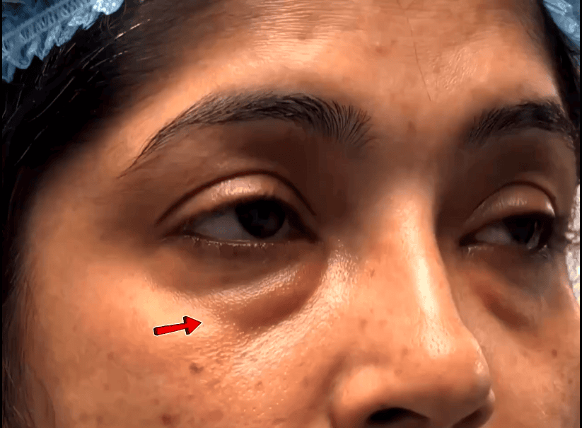 Bags lower eyelid