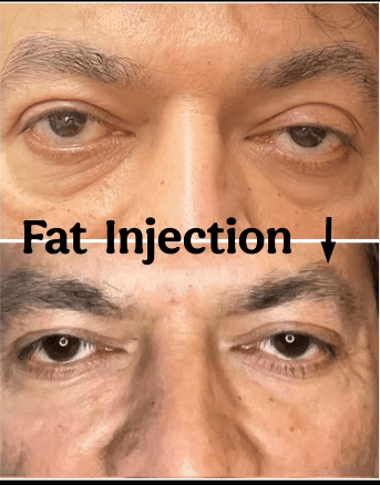 Fat injection