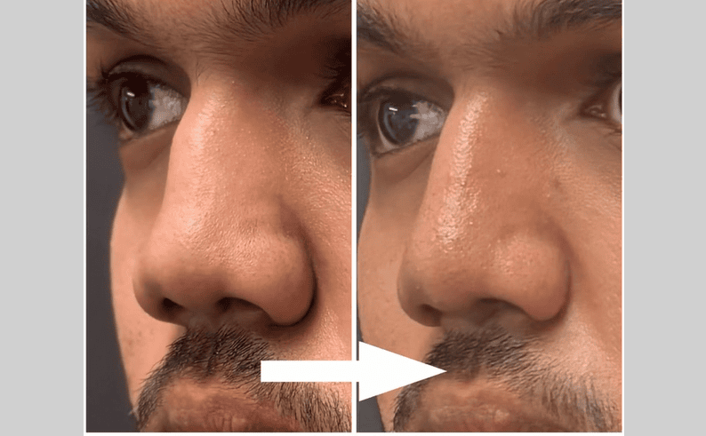 Twisted and Short  Nose