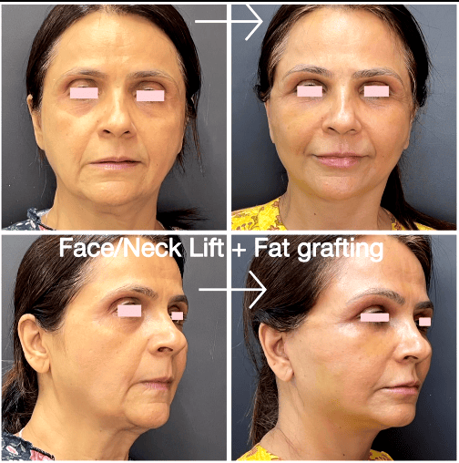 Face/Neck lift + fat grafting