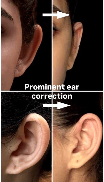 Prominent Ears