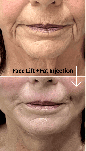 Face lift + Fat injection
