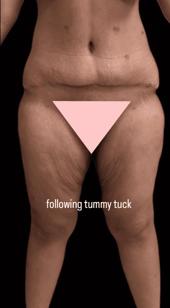 Revision Tummy Tuck + thigh lift