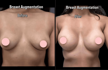 Breast Augmentation
