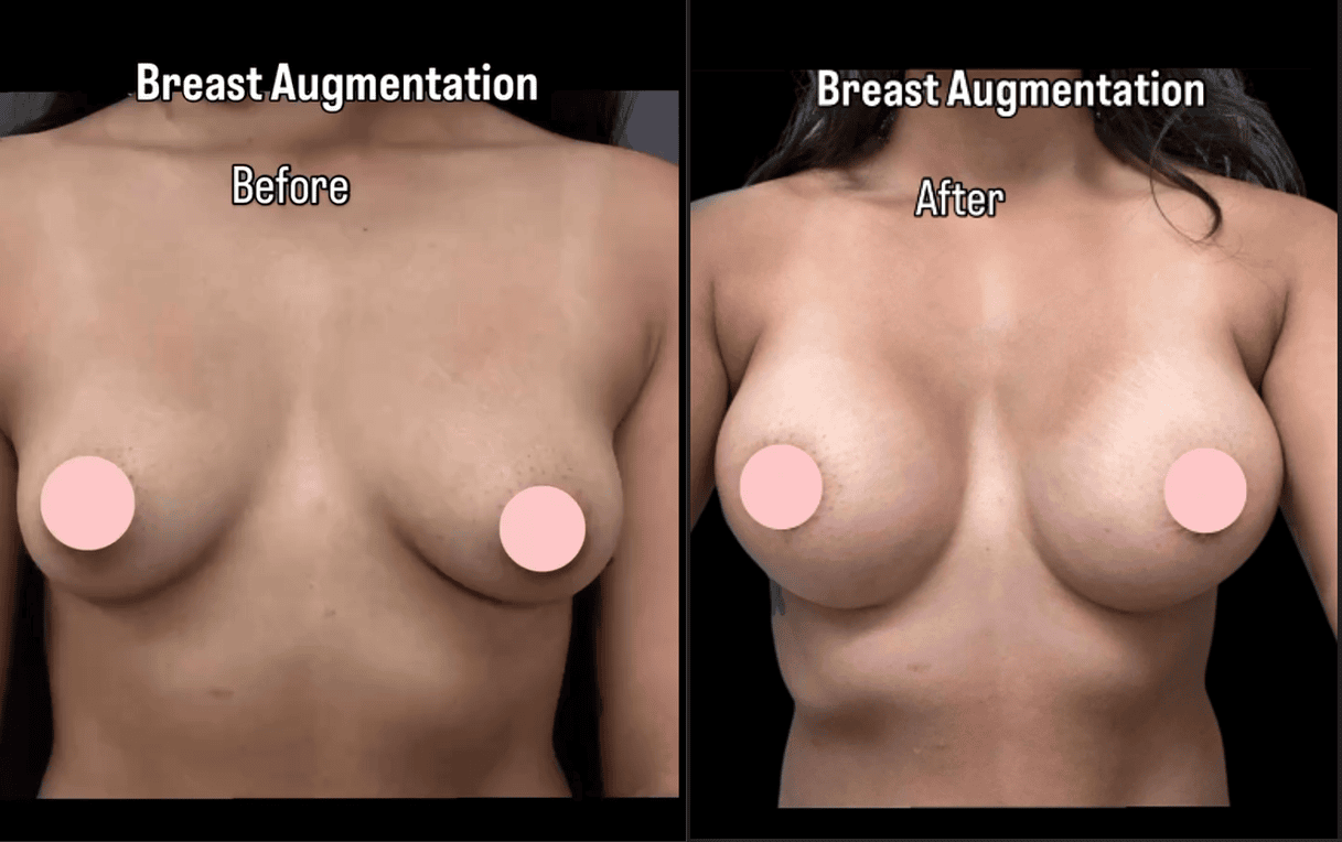 Breast Augmentation
