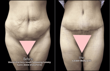 Revision Tummy Tuck