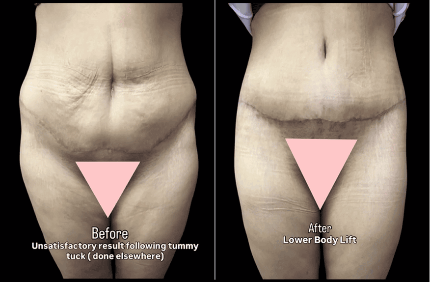 Revision Tummy Tuck