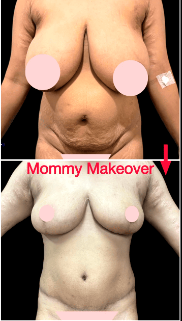 Is combination aesthetic surgery safe?