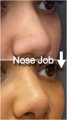 Nose Job ( Rhinoplasty)