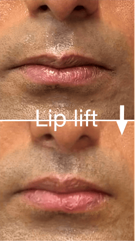 Lip Lift