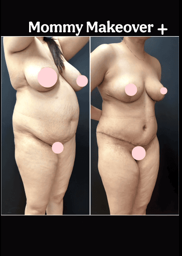 Mommy Makeover  + !