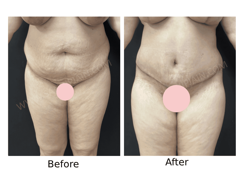Before<br>After: Following tummy tuck + lipo