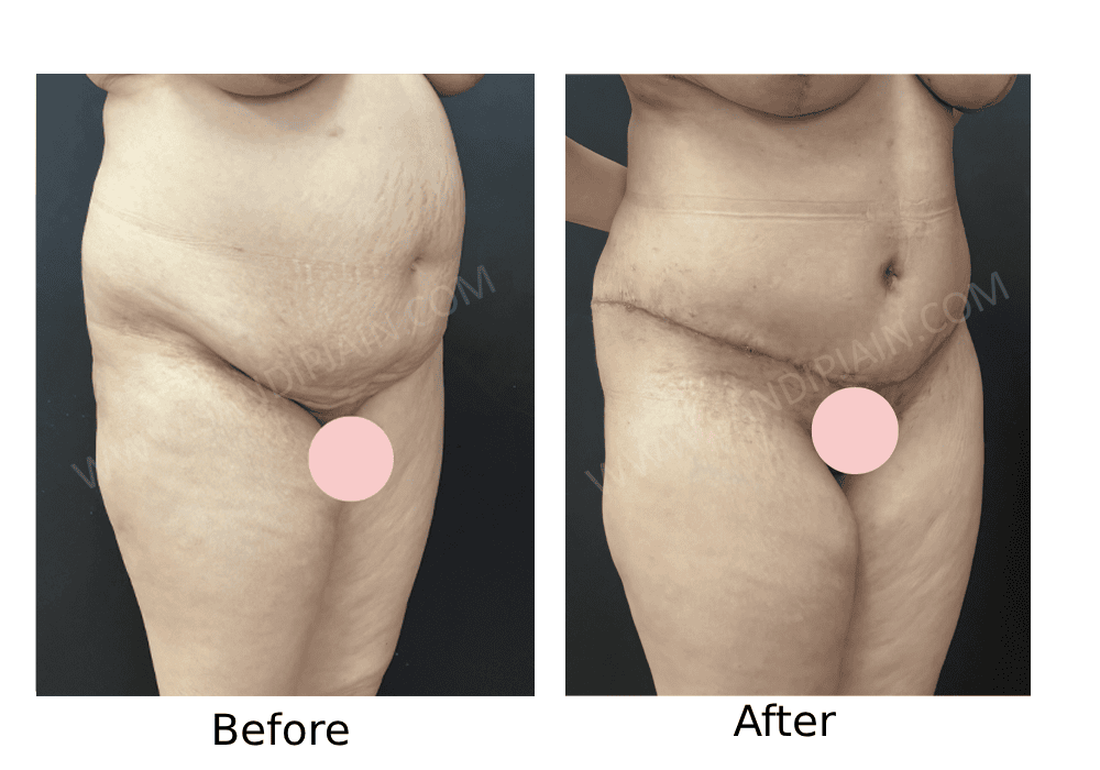 Before: Same patient as in fig 1 <br> After